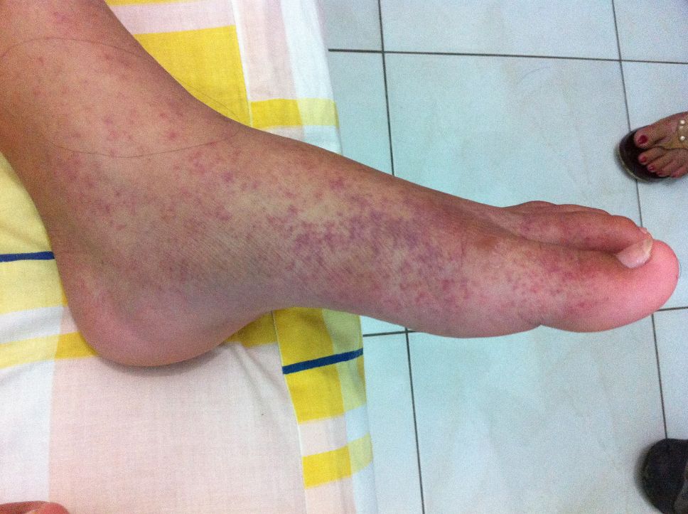 Virus chikungunya